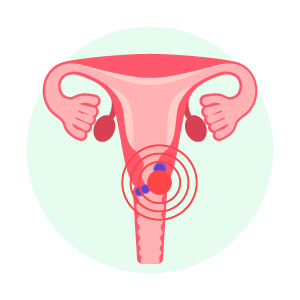 Cervical cancer