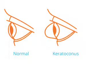 keratoconus2