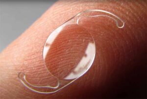 Closeup of cataract Lens resting on finger.